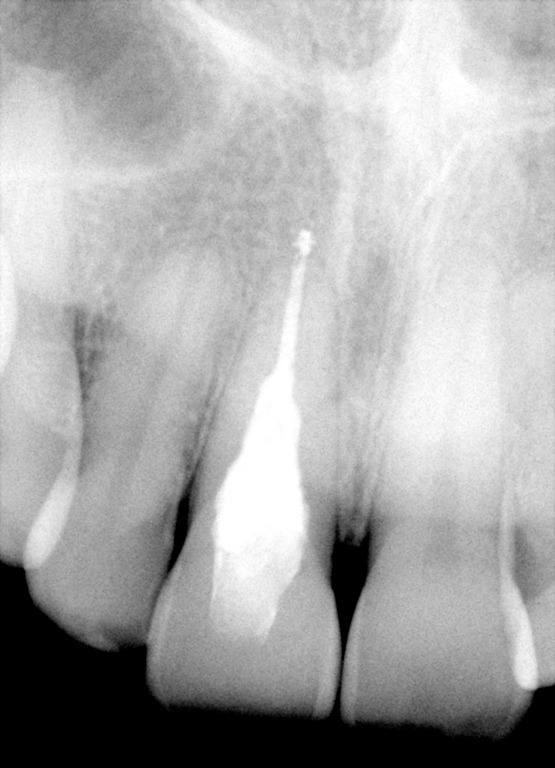 [Internal%2520Resorption%2520SB%2520final%2520radiograph012%255B3%255D.jpg]