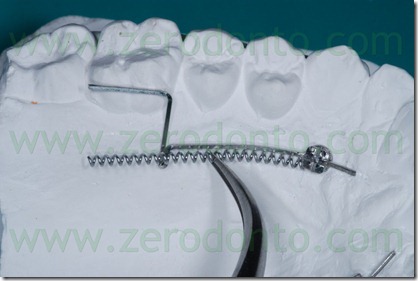 19 coil per distalizzare