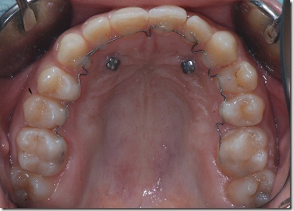 34b retainer attivo 34b retainer attivo