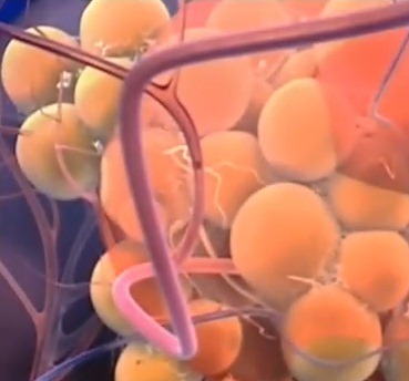 [Cellulite%255B3%255D.jpg]
