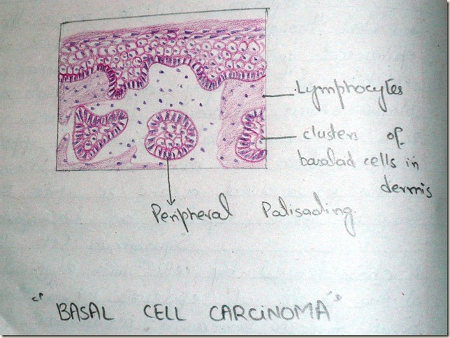 bcc-hand diagram of basal cell carcinoma