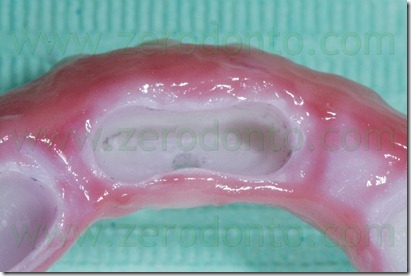 zirconia framework