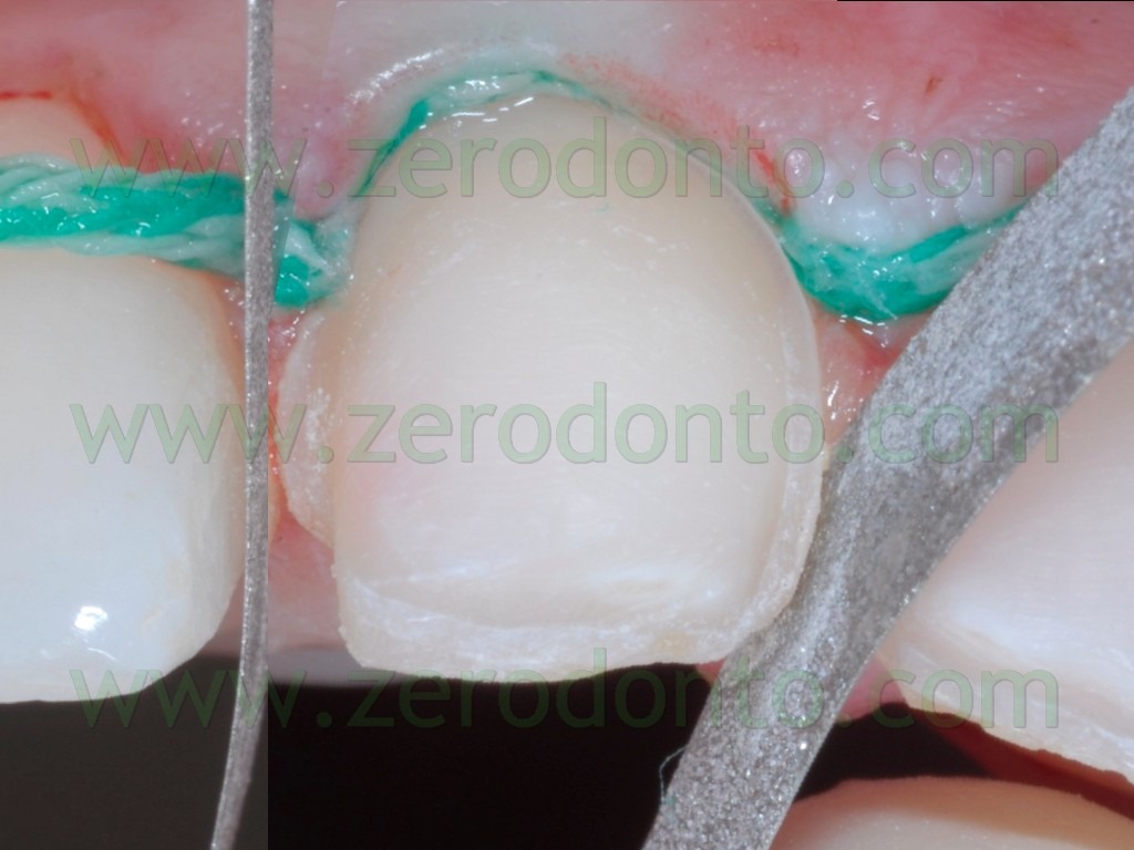 [62-preparazione-interprossimale-facc%255B1%255D.jpg]
