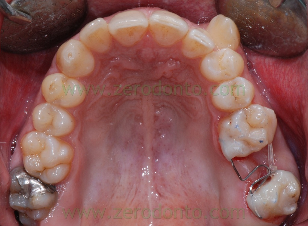 [14%2520chiusura%2520spazi%2520denti%255B2%255D.jpg]