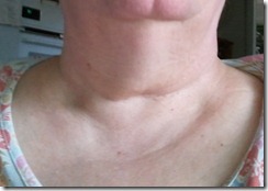 Neck changes 28 months post-op 2