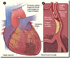 Ada banyak hal yang menimbulkan seseorang terkena serangan jantung Apa yang terjadi Ketika anda terkena Serangan Jantung