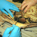 gall_bladder_liver.JPG