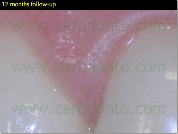 139 sopravvivenza breve medio lungo termine veneers ceramica composito resina