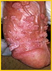 pene-con-VPH pene-con-vph.png