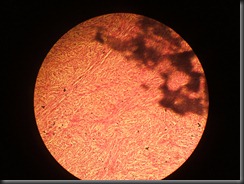 Fibrosarcoma high resolution histology slide tsnaps