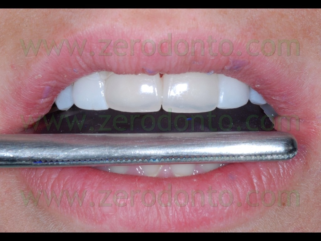 [81-articolazione-protrusiva-veneers3.jpg]