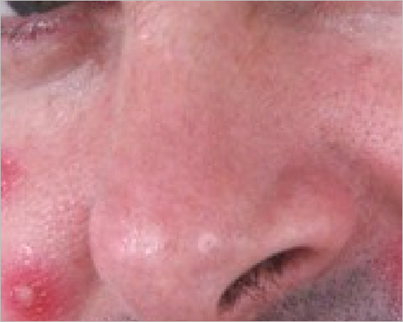 Rid a face of acne Rid-a-face-of-acne