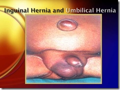 inguinal and umbilical hernia medical show