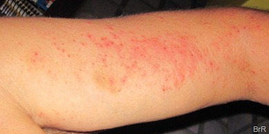 Allergie_auf_Arm Allergie_auf_Arm