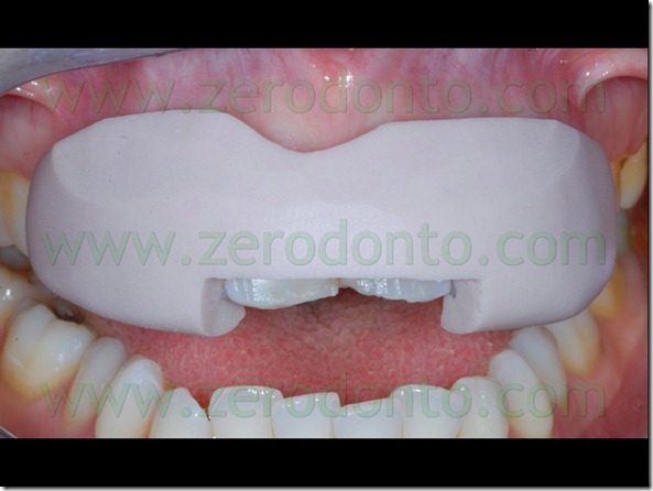 51 tecnica preparazione veneers