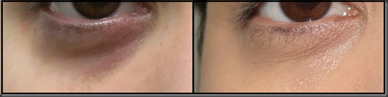 cubreojeras cubreojeras