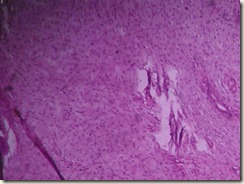 fibroadenoma breast histology slide
