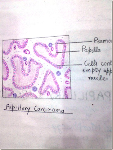 papillary carcinoma diagram histopathology