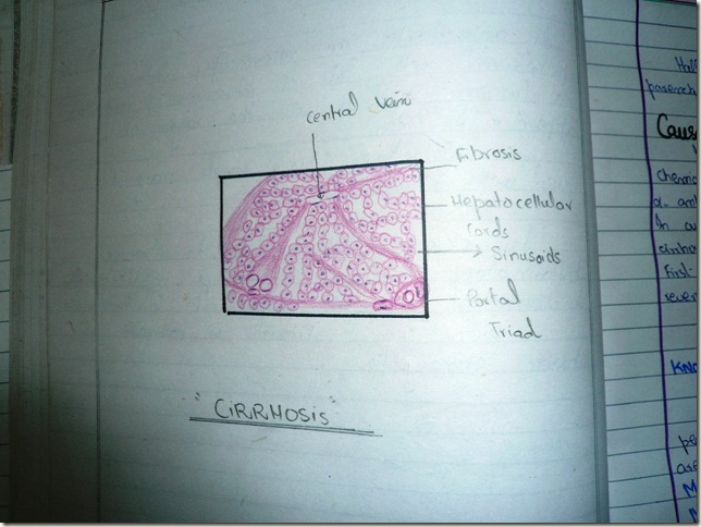 cirrhosis histopathology diagram