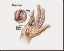 Hand-Pain-Trigger-Finger