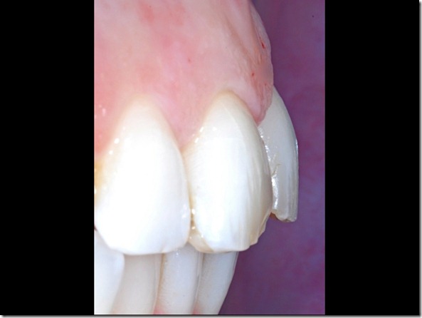 49 protrusione incisivi