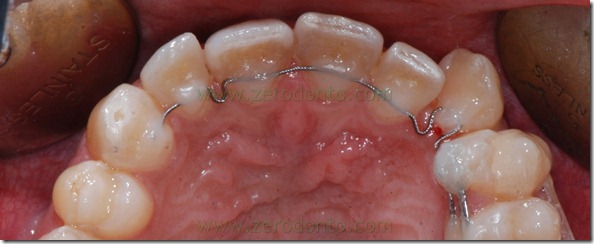 22 apparecchio denti
