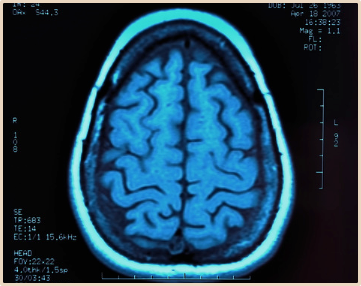 Dementia-vs-Parkinsonian-Disorders-Can-a-Panel-of-CSF-Tests-Make-the-Diagnosis?.png Dementia vs Parkinsonian Disorders Can a Panel of CSF Tests Make the Diagnosis