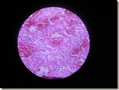 osteosarcoma photograph of histology slide
