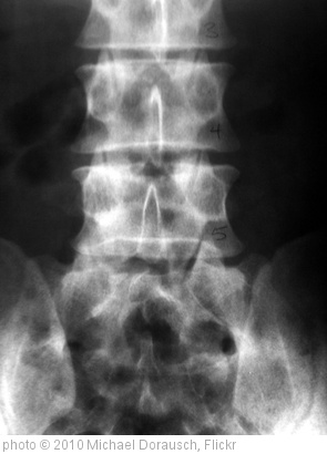 'Lumbar Spine X-Ray L4 L5 S1' photo (c) 2010, Michael Dorausch - license: http://creativecommons.org/licenses/by-sa/2.0/