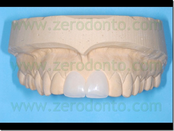 22 previsualizzazione veneer