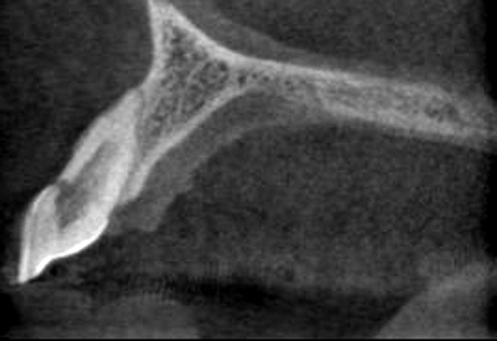 [CT%2520Buccal%2520Resorption002%255B4%255D.jpg]
