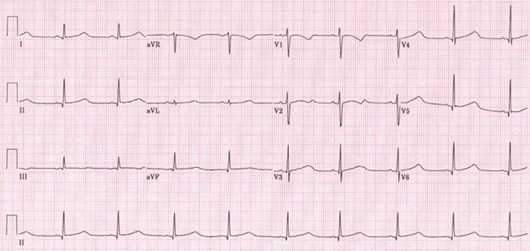 The Standard 12 Lead ECG The Standard 12 Lead ECG