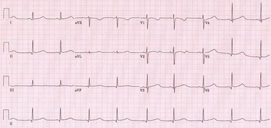 The Standard 12 Lead ECG