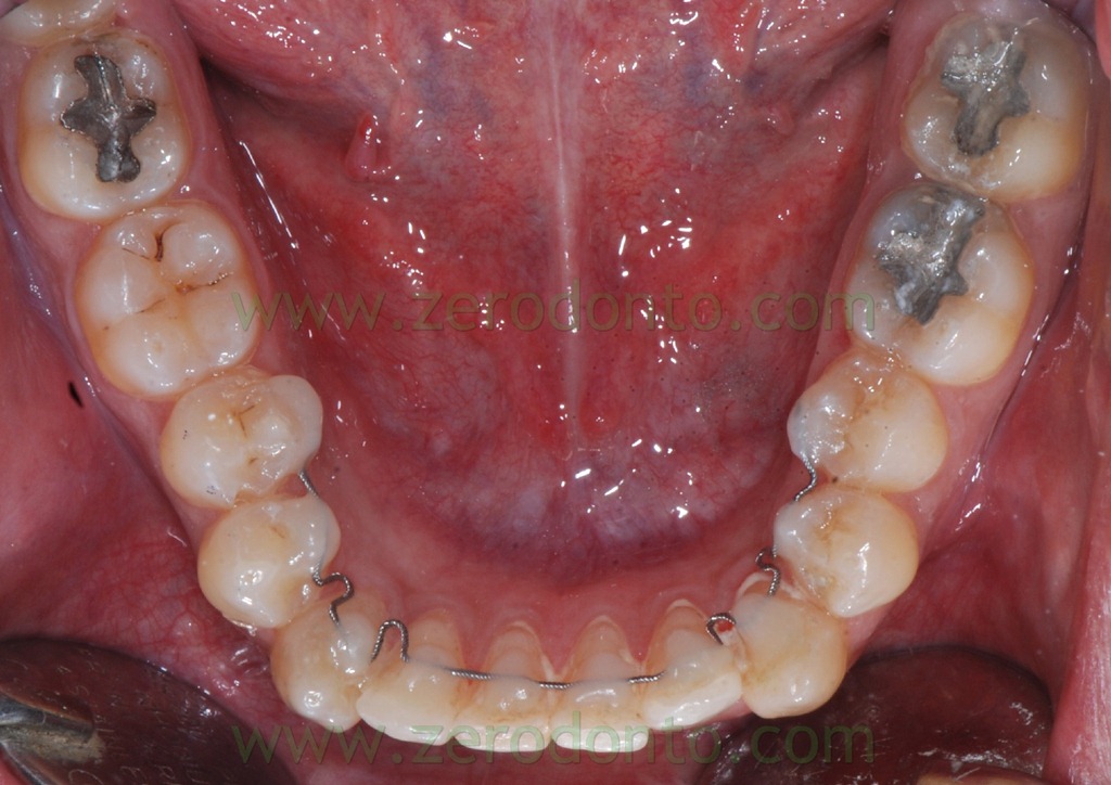 [21%2520allineamento%2520denti%255B2%255D.jpg]