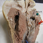 heart_with_pins_labeled.JPG