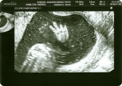 Baby A Baby Girl hand 18 Weeks
