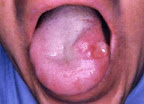 sifilis-en-la-lengua.jpg