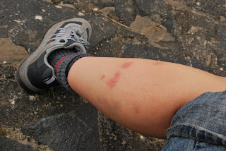  &ndash; Bedbug bites 4 months after the attack. There were over 60 welts initially. The bruises are the healed ones