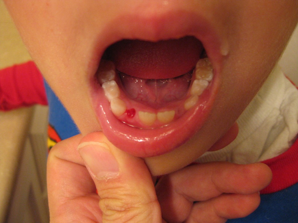[missing_tooth1%255B7%255D.jpg]