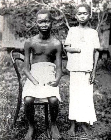 Amputated_Congolese_youth