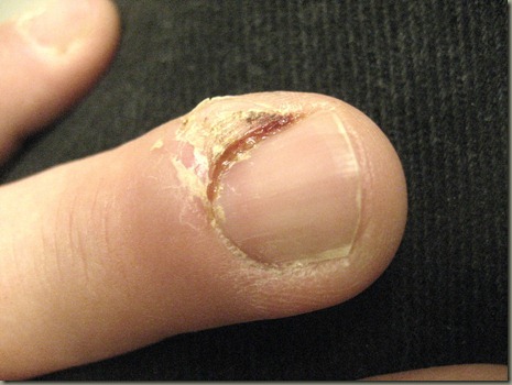The Finger Pre Treatment