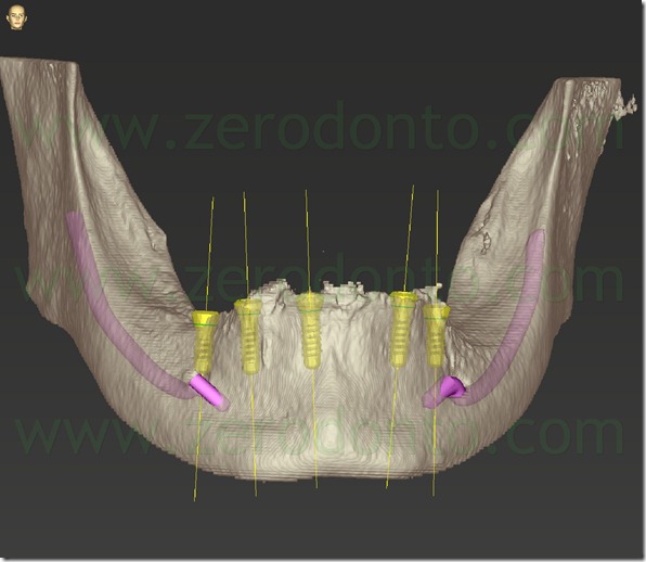 - (73) impianti roxolid