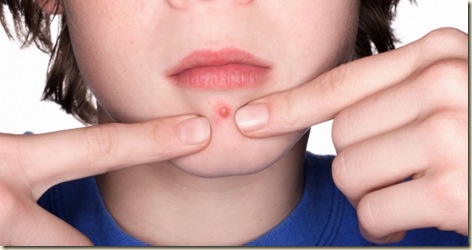 tratamientas para prevenir el acne tratamientas para prevenir el acne