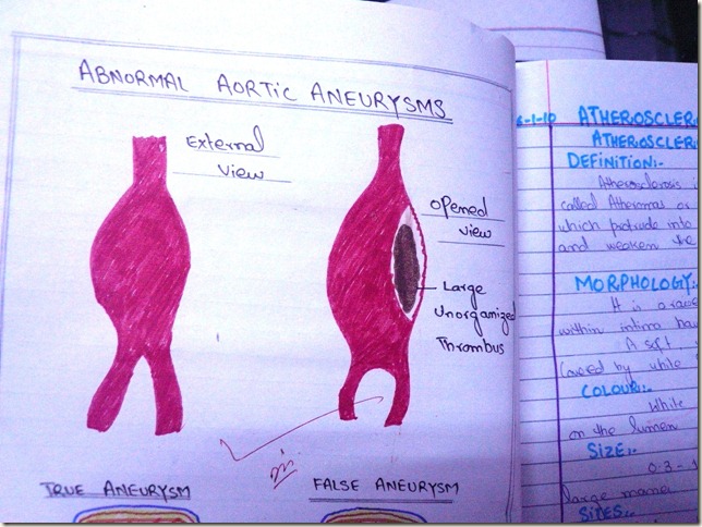 aortic aneurysm- true aortic aneurysm and false aortic aneurysm hand made diagram- pathology