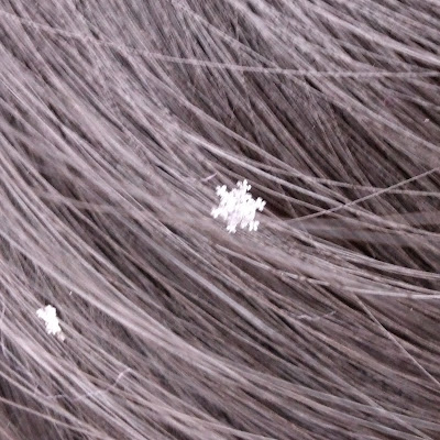 髪に落ちた雪の結晶