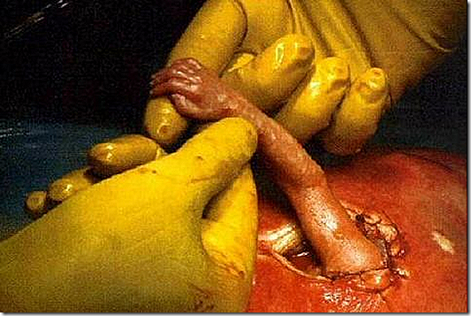 aborto