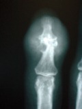 erosiones óseas en la articulación final característicos de la gota