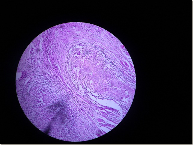 tuberculous granuloma histopathology