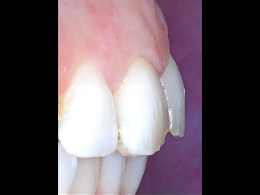 [49-protrusione-incisivi1.jpg]