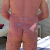 PlaquePsoriasis1.jpg